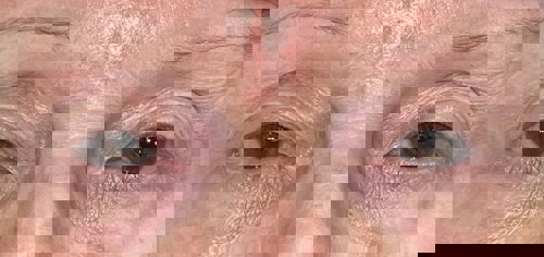 72 Years Old Upper Lid Blepharoplasty And Ptosis Before Surgery