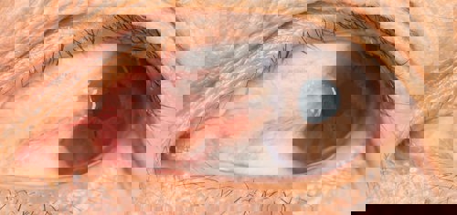 Pterygium Surgery