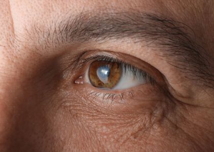 OCL Vision Cataract Surgery